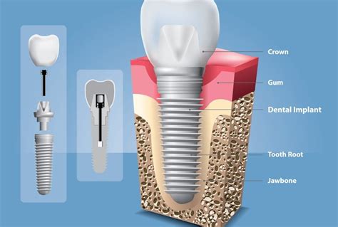 dental implant materials roxolid  titanium  ceramic