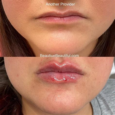 nurse shara latorre lip flip technique beautique medical
