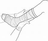Cast Leg Clipart Arm Clip Drawing Cliparts Library sketch template