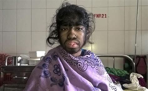 Bangladesh Girl Seeks Help For Rare Excess Hair Condition