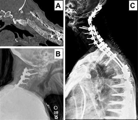 cureus cervical fracture subluxation in a patient with a prior c2