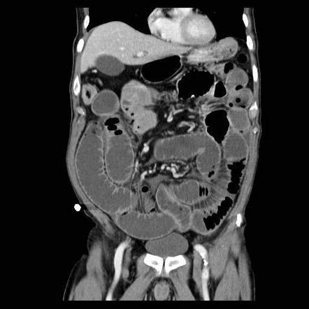 norma ramos small bowel obstruction ct  oral contrast