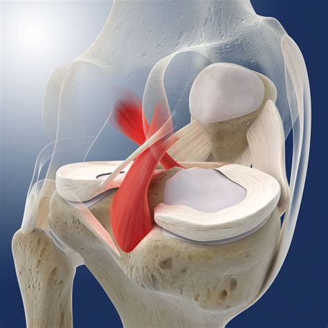 posterior cruciate ligament tears  treatment