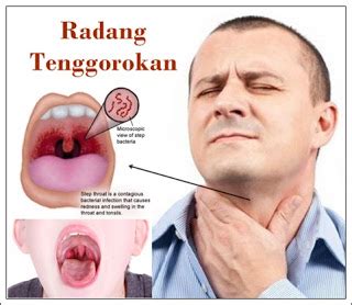 penyebab   mengobati radang tenggorokan secara alami permathic