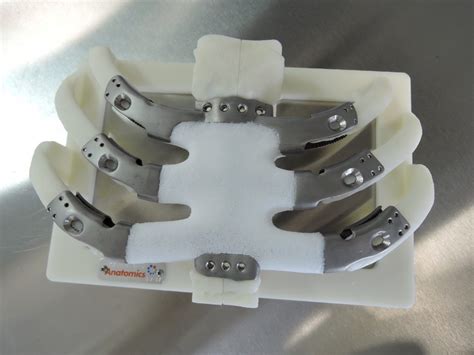 3d Printed Composite Sternum And Rib Cage Implanted For The First Time