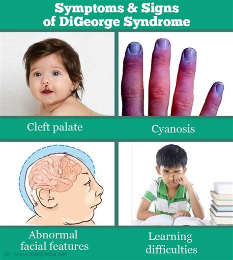 digeorge syndrome  symptoms diagnosis treatment prognosis