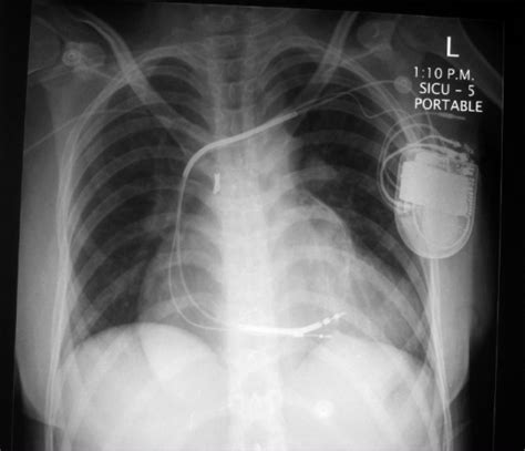 Admission Chest X Ray Showing Evidence Of Previous Ster
