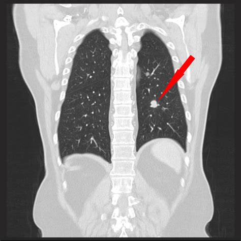 ct vorsorge lungebrustkorb radiologie zentrum neu ulm