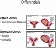 Bildergebnis für Uterus Didelphys. Größe: 116 x 100. Quelle: www.semanticscholar.org