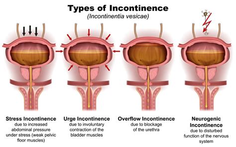types  stress urinary incontinence chicago urogynecology