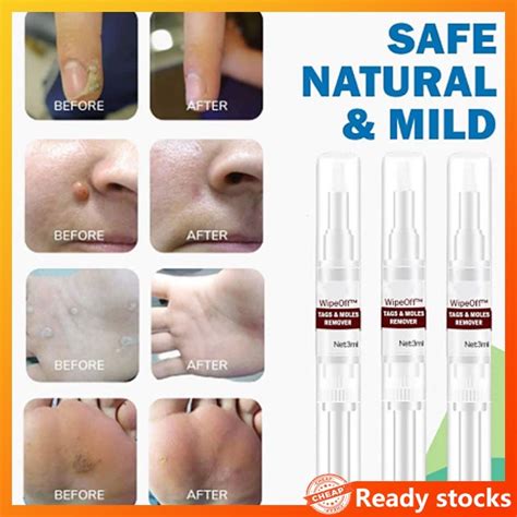 ready stock 5ml skin tag remover pen medical wart remover skin tag mole