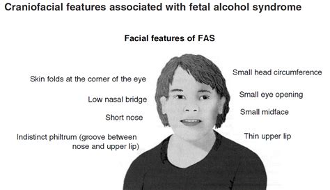 fetal alcohol syndrome is the west ready for islam