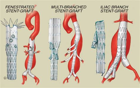 endovascular repair  complex aortic aneurysms mayo clinic