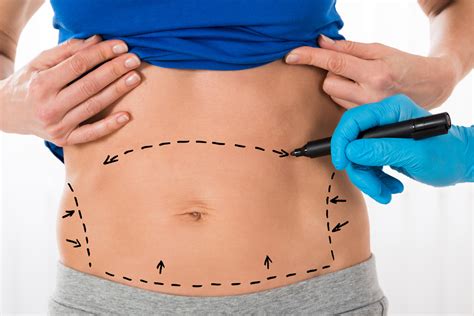 liposuction  coolsculpting whats  difference smart lipo