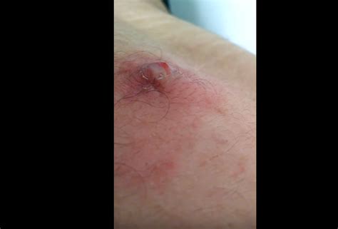 popping ingrown hair infection on the back new pimple