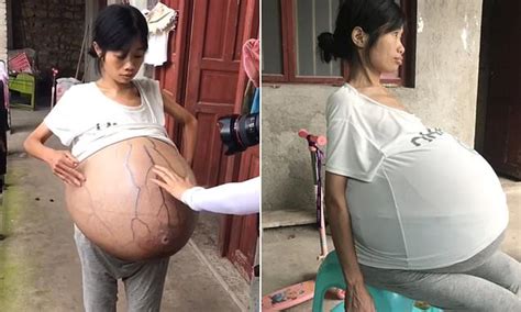 chinese woman s belly grows to 44lbs due to mystery condition daily