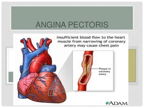 angina pectoris icd  cm