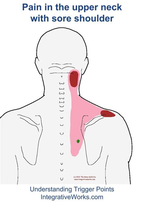 Pin On Upper Back Trigger Point Pain