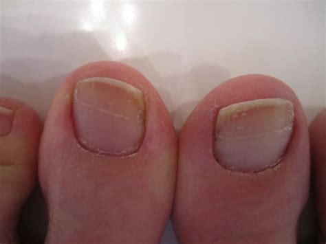 Horizontal Ridges On Thumb And Big Toe Nails Nail Ftempo