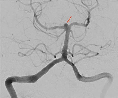 aneurysm   tip   arteria basilaris ranatomy
