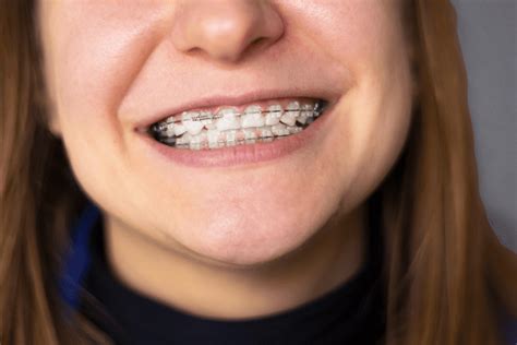 5 Simple Tips To Relieve Sore Teeth After Braces Tightening Dunegan