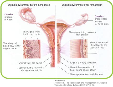 causes of vaginal atrophy gynatrof
