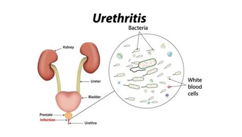 What Is Urethritis Know The Causes Symptoms And Treatment