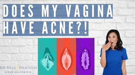 Does My Vagina Have Acne Girl Talk With Dr Rejuvenation Youtube