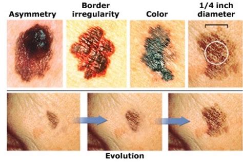 The Abcd Method Of Early Skin Cancer Detection Sarah Interman