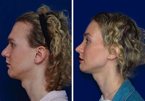 facial feminization surgery before after facial gender confirmation