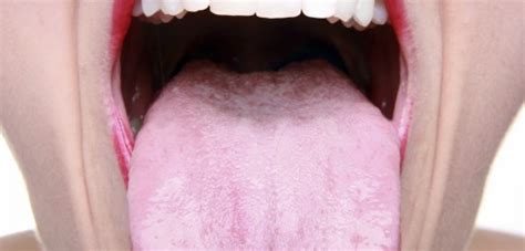 vancouver dentists cleaning your tongue tips from