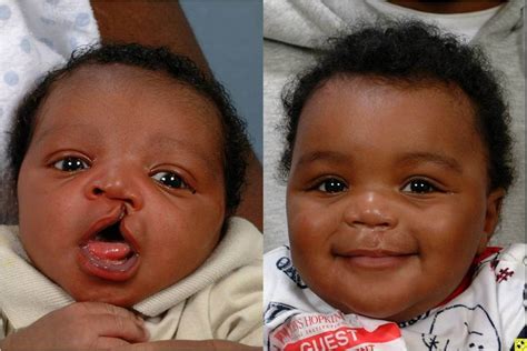 Cleft Lip And Cleft Palate Johns Hopkins Facial Plastic And