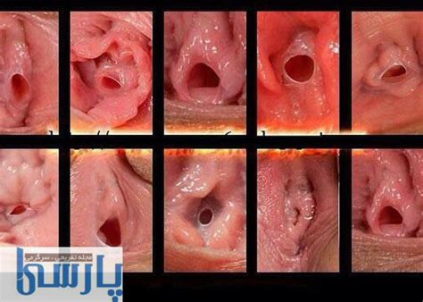 انواع پرده بکارت و عکس پرده بکارت با توضیح پارسی وان