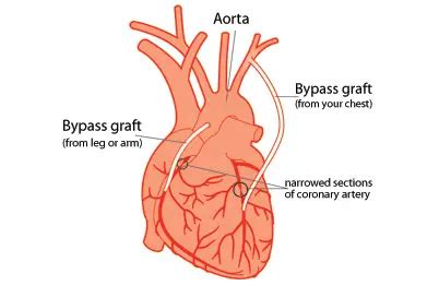 eat  heart bypass surgery diet instruction