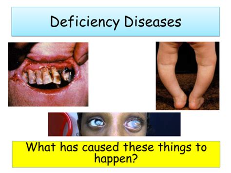 deficiency diseases teaching resources