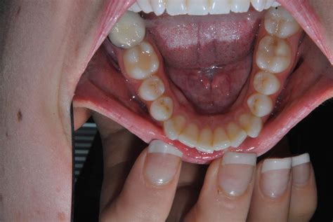 dr tal lewingers blog   invisalign appointments