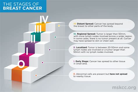 Breast Cancer Stages 0 1 2 3 And 4 Memorial Sloan Kettering Cancer