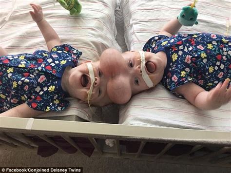 talk to kemi ttk co joined twins successfully separated through surgery