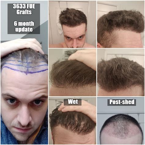 hair transplant results  months   grafts  fue