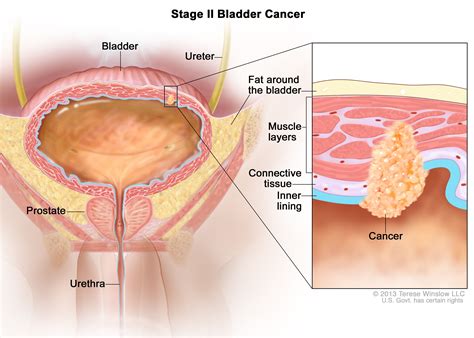 bladder cancer treatment pdqpatient version national cancer institute