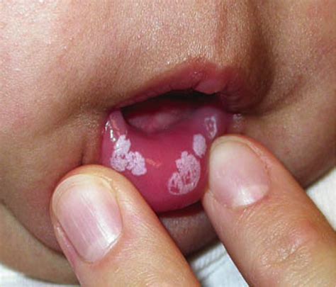thrush mouth treatment tubezzz porn photos