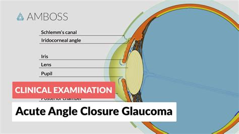 acute angle closure glaucoma youtube
