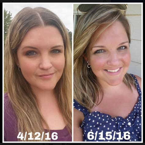 hypothyroid in photos before and after stop the thyroid madness
