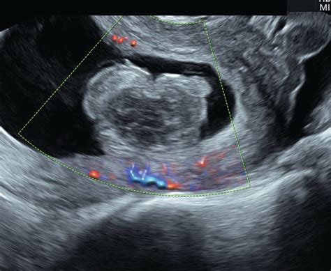 ultrasound   critical tool  managing miscarriage