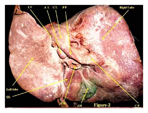Figure 2 Hypoplastic Left Lobe Of Liver With Accessory Caudate Lobe