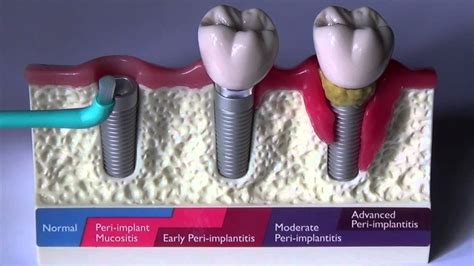 clean  implant  supports  denture youtube