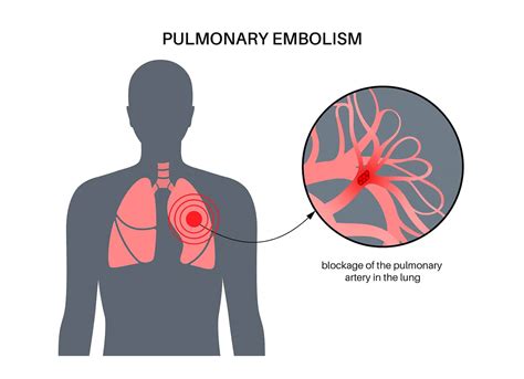 3 Symptoms Of Pulmonary Embolism Kingwood Emergency Hospital