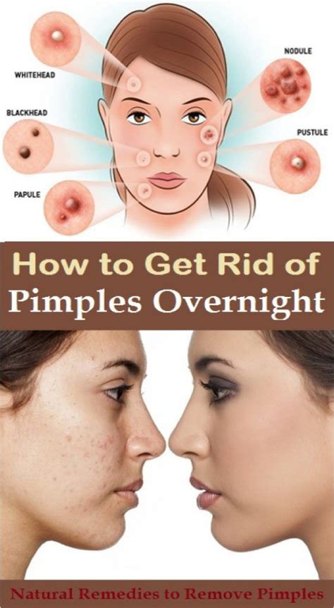 ways  eliminate pimples overnight naturally  fast