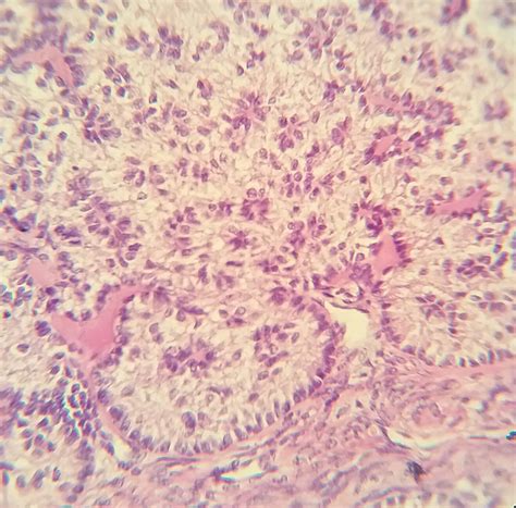 pathology outlines sex cord tumor with annular tubules