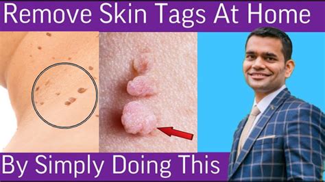 remove skin tags home remedies to remove skin tags dr vivek joshi